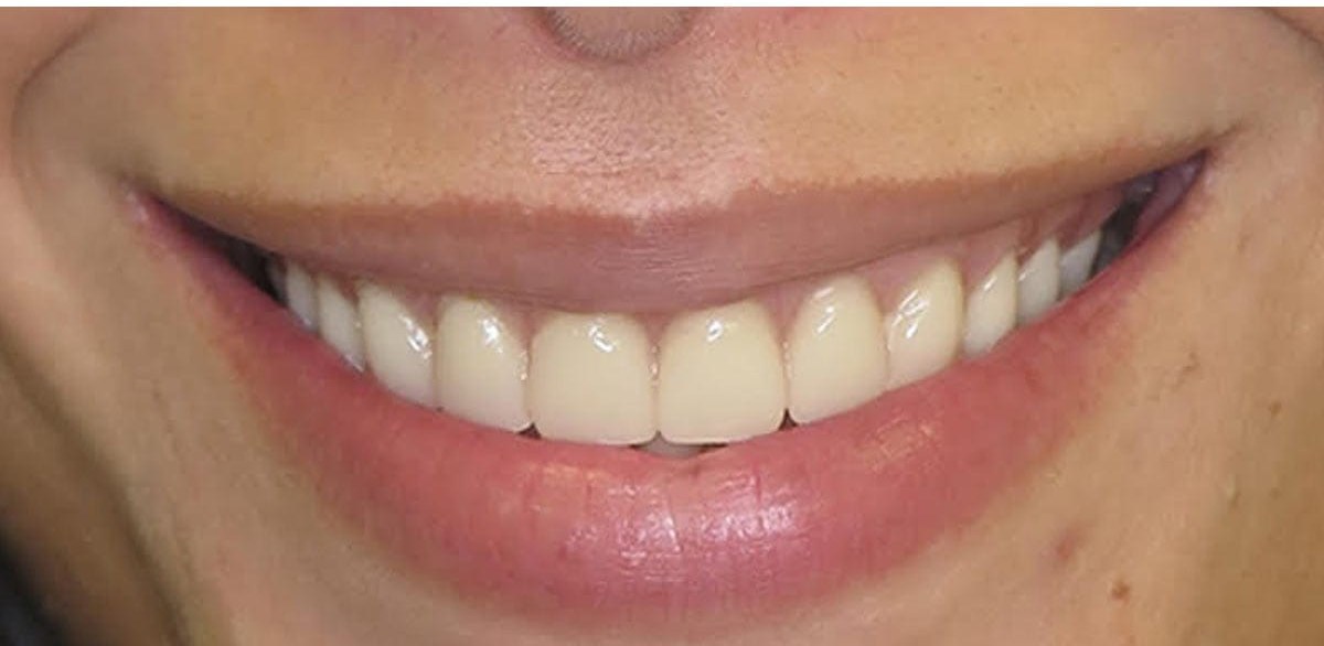 After full-arch implant restoration