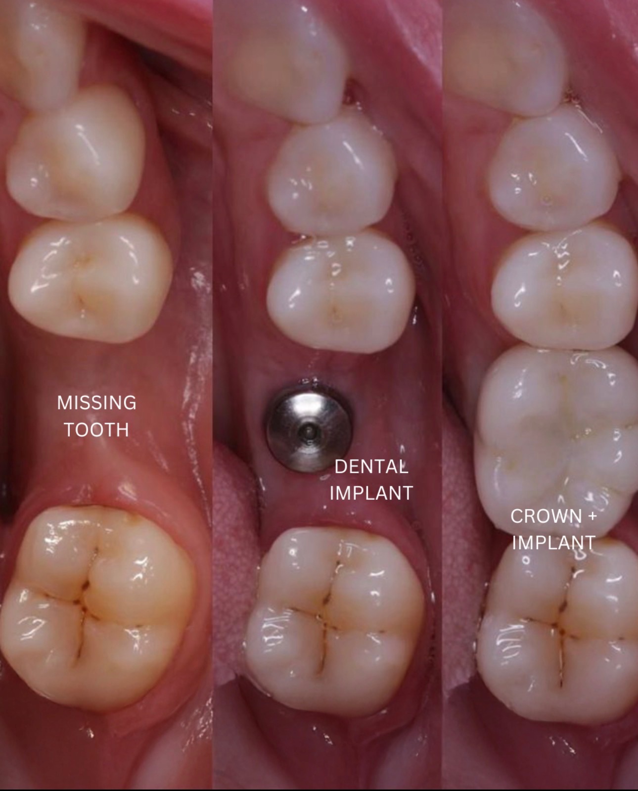 How a dental implant replaces a missing tooth