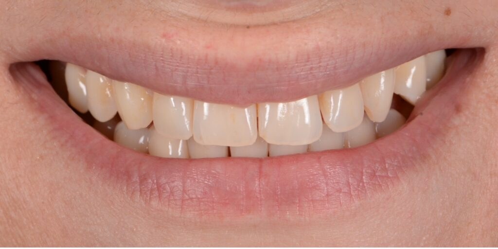 Before porcelain veneers