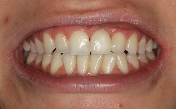 After front-tooth implant