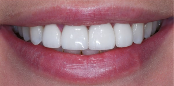 After implant #9