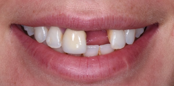 Before implant #9